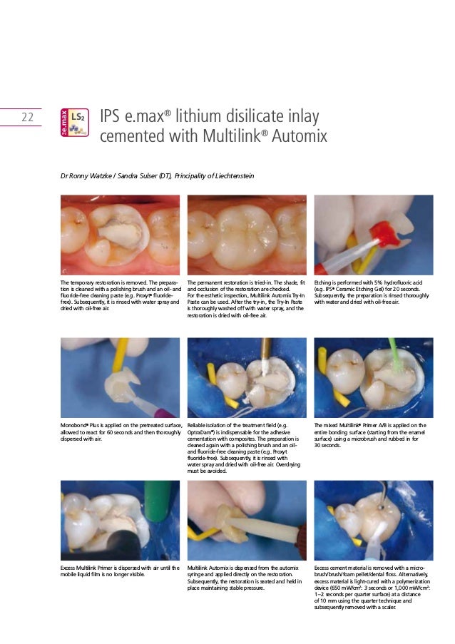 Ips E Max Clinical Guide