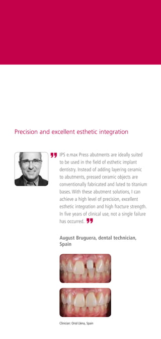 Precision and excellent esthetic integration


             „   IPS e.max Press abutments are ideally suited
             ...
