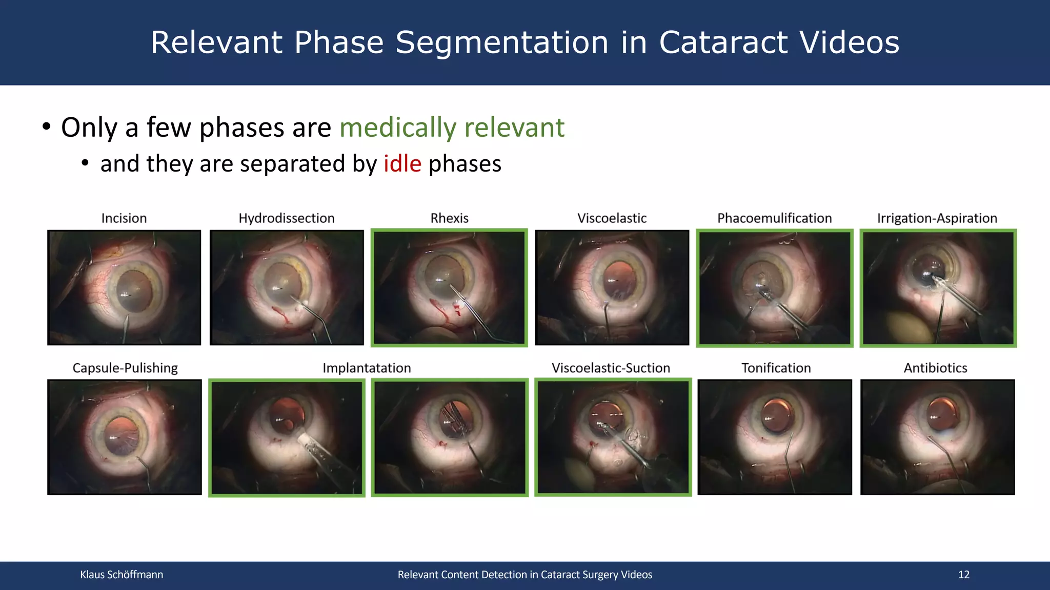 • Only a few phases are medically relevant
• and they are separated by idle phases
Relevant Phase Segmentation in Cataract Videos
Relevant Content Detection in Cataract Surgery Videos
Klaus Schöffmann 12
 