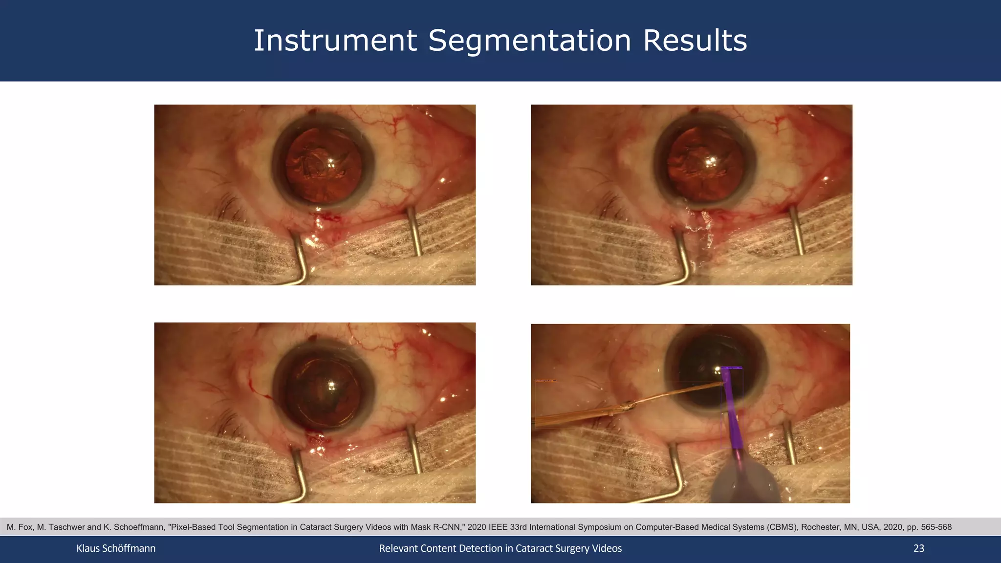Instrument Segmentation Results
Klaus Schöffmann Relevant Content Detection in Cataract Surgery Videos 23
M. Fox, M. Taschwer and K. Schoeffmann, "Pixel-Based Tool Segmentation in Cataract Surgery Videos with Mask R-CNN," 2020 IEEE 33rd International Symposium on Computer-Based Medical Systems (CBMS), Rochester, MN, USA, 2020, pp. 565-568
 