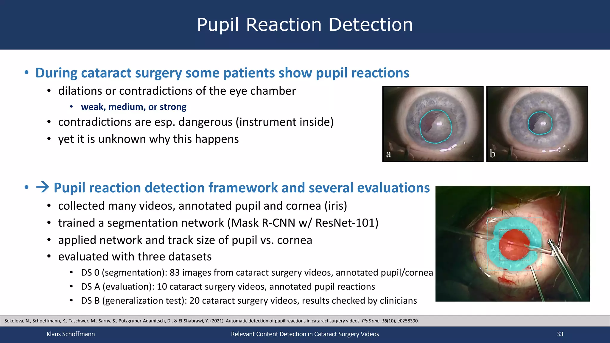 • During cataract surgery some patients show pupil reactions
• dilations or contradictions of the eye chamber
• weak, medium, or strong
• contradictions are esp. dangerous (instrument inside)
• yet it is unknown why this happens
• à Pupil reaction detection framework and several evaluations
• collected many videos, annotated pupil and cornea (iris)
• trained a segmentation network (Mask R-CNN w/ ResNet-101)
• applied network and track size of pupil vs. cornea
• evaluated with three datasets
• DS 0 (segmentation): 83 images from cataract surgery videos, annotated pupil/cornea
• DS A (evaluation): 10 cataract surgery videos, annotated pupil reactions
• DS B (generalization test): 20 cataract surgery videos, results checked by clinicians
Pupil Reaction Detection
Relevant Content Detection in Cataract Surgery Videos
Sokolova, N., Schoeffmann, K., Taschwer, M., Sarny, S., Putzgruber-Adamitsch, D., & El-Shabrawi, Y. (2021). Automatic detection of pupil reactions in cataract surgery videos. PloS one, 16(10), e0258390.
Klaus Schöffmann 33
 