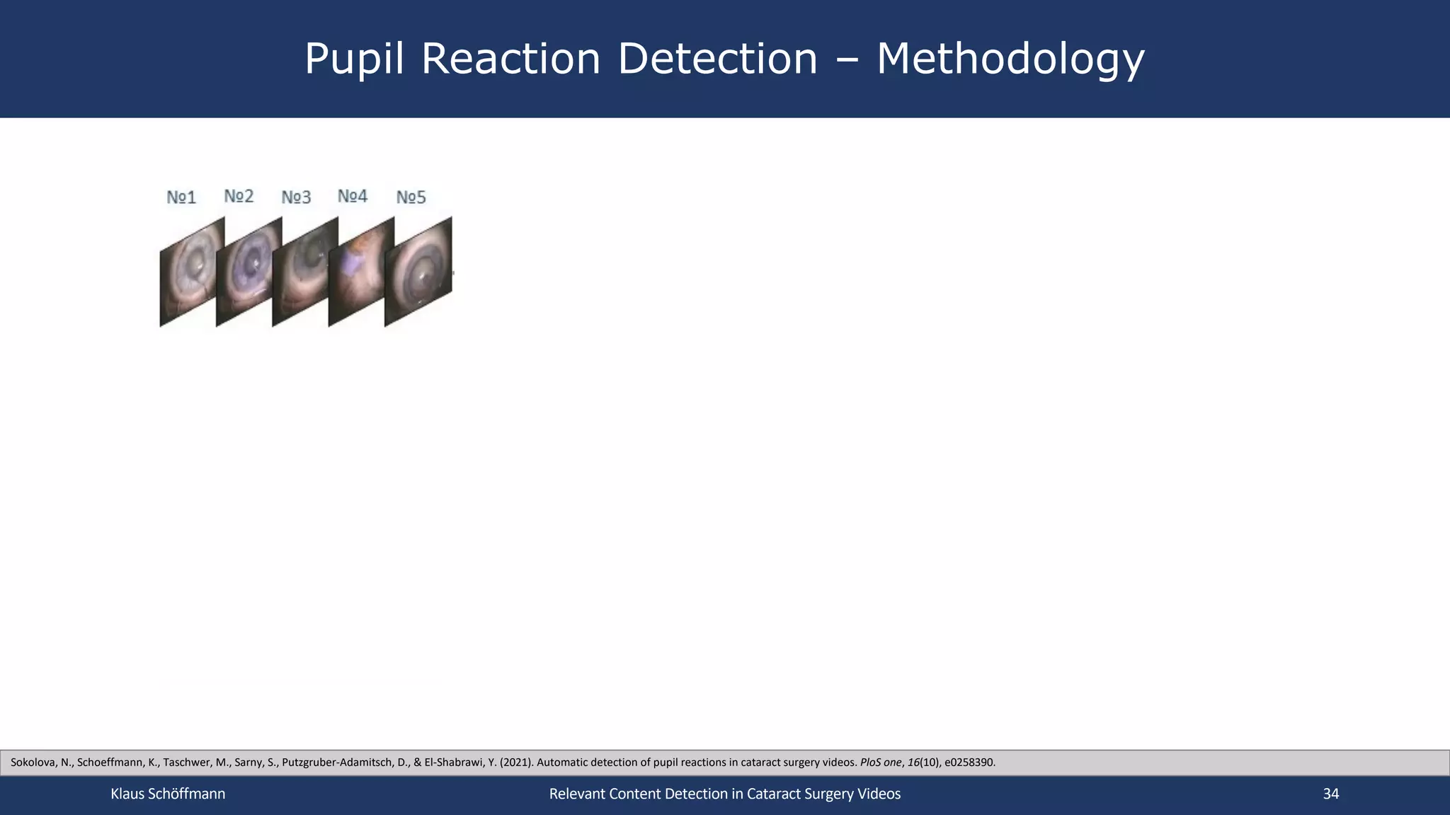Pupil Reaction Detection – Methodology
Relevant Content Detection in Cataract Surgery Videos
✓ ✗
✓ ✗ ✓
✓ ✓ ✓
✓ ✓
Klaus Schöffmann 34
Sokolova, N., Schoeffmann, K., Taschwer, M., Sarny, S., Putzgruber-Adamitsch, D., & El-Shabrawi, Y. (2021). Automatic detection of pupil reactions in cataract surgery videos. PloS one, 16(10), e0258390.
 