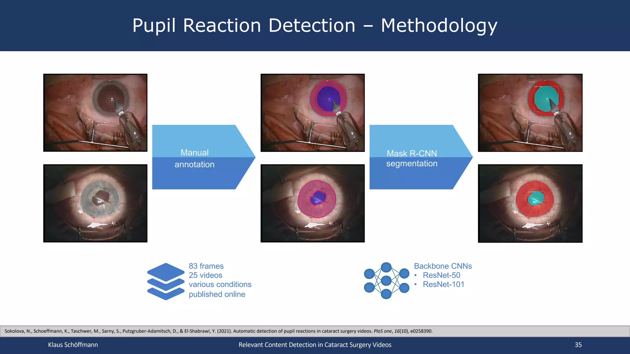 Pupil Reaction Detection – Methodology
Relevant Content Detection in Cataract Surgery Videos
Manual
annotation
Mask R-CNN
segmentation
Backbone CNNs
• ResNet-50
• ResNet-101
83 frames
25 videos
various conditions
published online
Klaus Schöffmann 35
Sokolova, N., Schoeffmann, K., Taschwer, M., Sarny, S., Putzgruber-Adamitsch, D., & El-Shabrawi, Y. (2021). Automatic detection of pupil reactions in cataract surgery videos. PloS one, 16(10), e0258390.
 