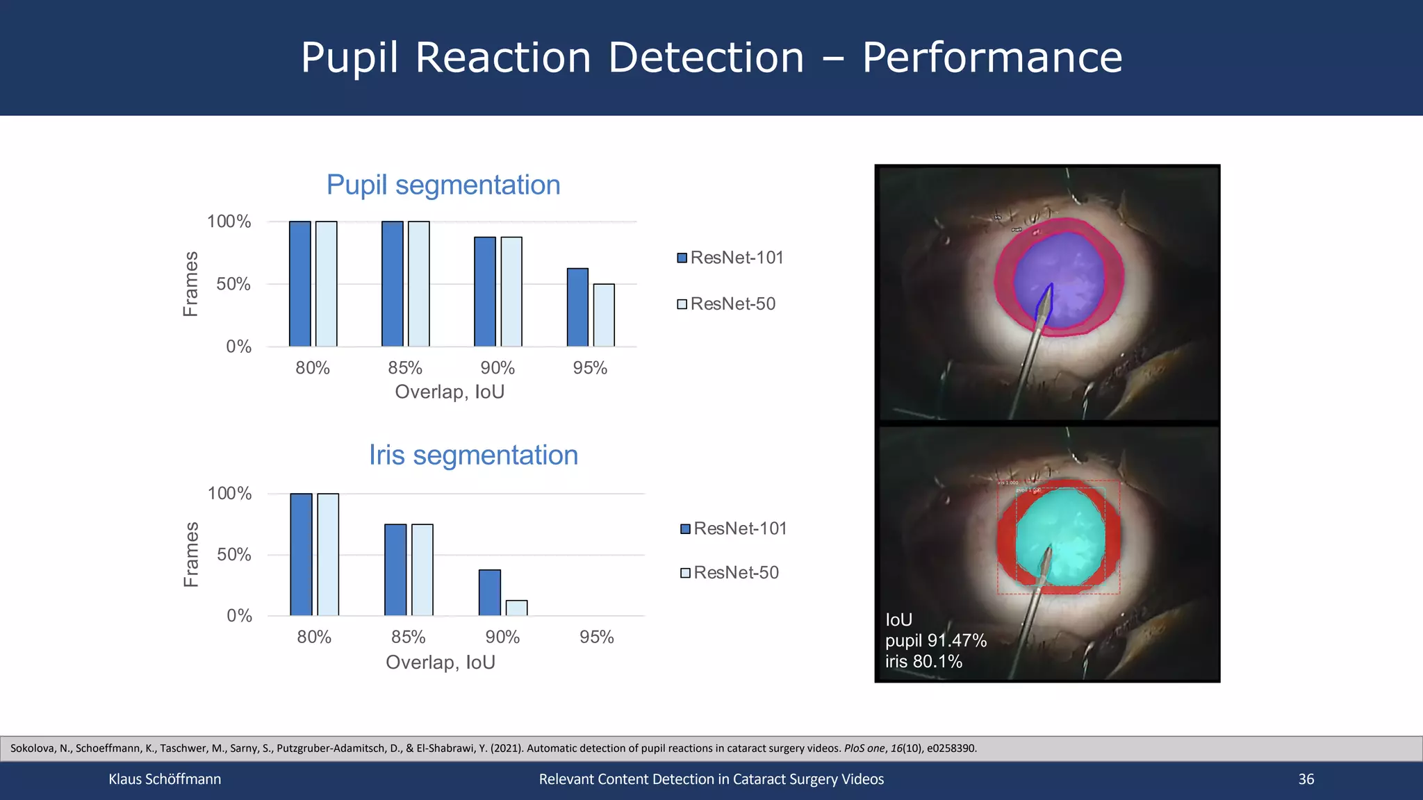 Pupil Reaction Detection – Performance
Relevant Content Detection in Cataract Surgery Videos
IoU
pupil 91.47%
iris 80.1%
0%
50%
100%
80% 85% 90% 95%
Frames
Overlap, IoU
Iris segmentation
ResNet-101
ResNet-50
0%
50%
100%
80% 85% 90% 95%
Frames
Overlap, IoU
Pupil segmentation
ResNet-101
ResNet-50
Klaus Schöffmann 36
Sokolova, N., Schoeffmann, K., Taschwer, M., Sarny, S., Putzgruber-Adamitsch, D., & El-Shabrawi, Y. (2021). Automatic detection of pupil reactions in cataract surgery videos. PloS one, 16(10), e0258390.
 