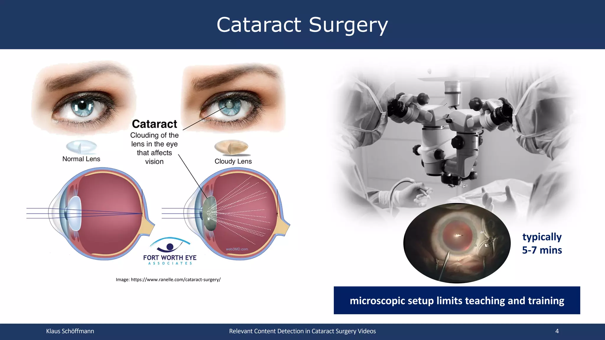 Cataract Surgery
Klaus Schöffmann Relevant Content Detection in Cataract Surgery Videos 4
microscopic setup limits teaching and training
Image: https://www.ranelle.com/cataract-surgery/
typically
5-7 mins
 
