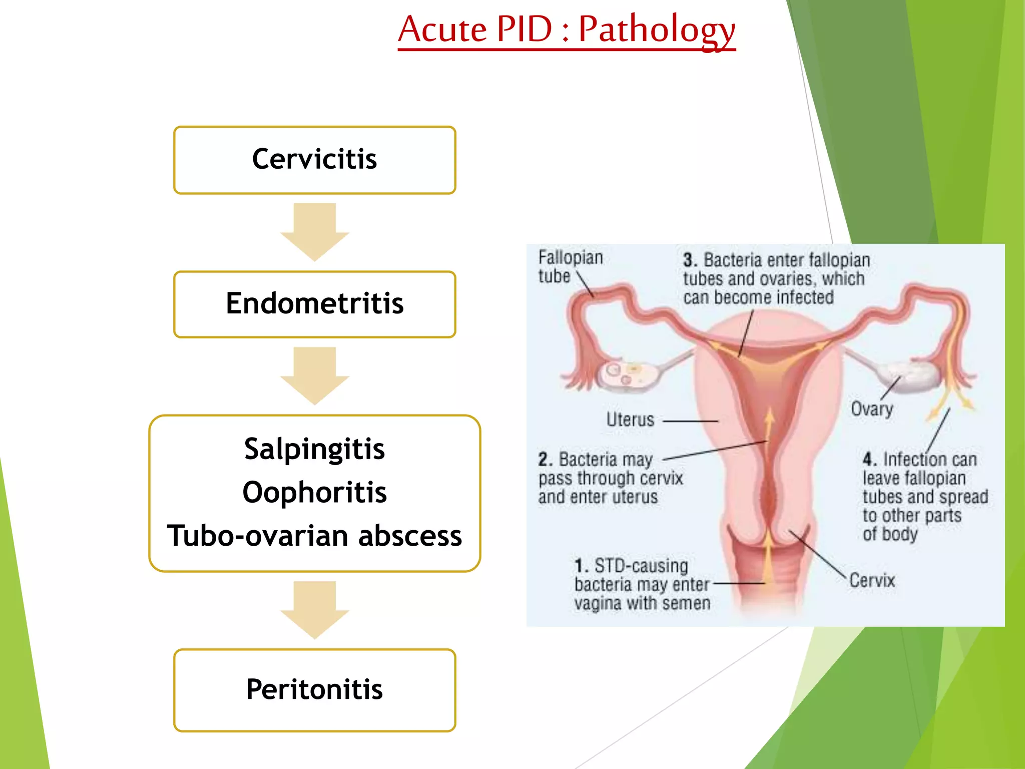 Pelvic inflammatory disease (pid) | PPSX