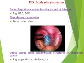 PID : Mode of transmission 
Gynecological procedures favoring ascend of infection 
 E.g. D&C, D&E 
Blood-borne transmission 
 Pelvic tuberculosis 
Direct spread from contaminated structures in abdominal 
cavity 
 E.g. Appendicitis, cholecystitis 
 