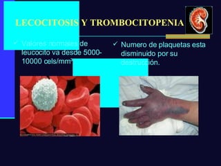 LECOCITOSIS Y TROMBOCITOPENIA Valores normales de leucocito va desde 5000-10000 cels/mm ³ Numero de plaquetas esta disminuido por su destrucción. 
