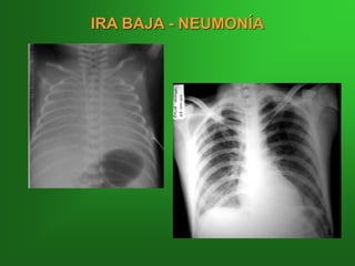 IRA BAJA - NEUMONÍA
 