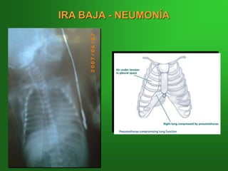 IRA BAJA - NEUMONÍA
 