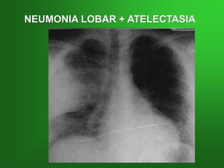 NEUMONIA LOBAR + ATELECTASIA
 