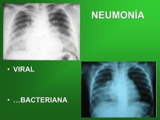 NEUMONÍA
• VIRAL
• …BACTERIANA
 