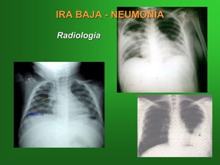 Radiología
IRA BAJA - NEUMONÍA
 