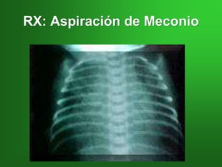 RX: Aspiración de Meconio
 
