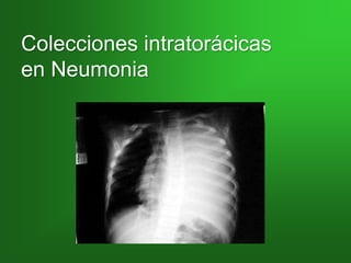 Colecciones intratorácicas
en Neumonia
 