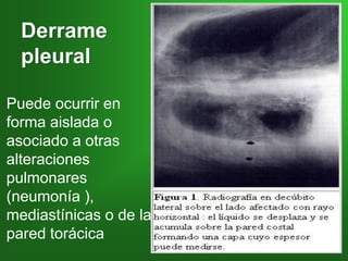 Derrame
pleural
Puede ocurrir en
forma aislada o
asociado a otras
alteraciones
pulmonares
(neumonía ),
mediastínicas o de la
pared torácica
 