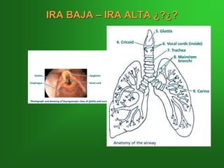 IRA BAJA – IRA ALTA ¿?¿?
 