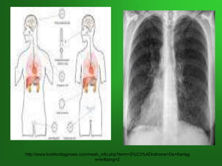 http://www.lookfordiagnosis.com/mesh_info.php?term=S%C3%ADndrome+De+Kartag
ener&lang=2
 