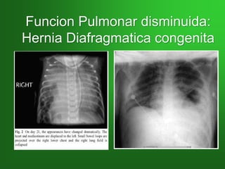 Funcion Pulmonar disminuida:
Hernia Diafragmatica congenita
 