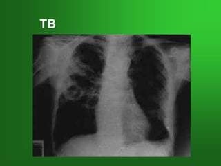 TB
 