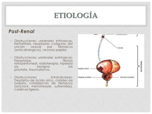 cadenas ligeras e insuficiencia renal insuficiencia renal aguda en el adulto mayor cadenas ligeras e insuficiencia renal insuficiencia renal aguda en el adulto mayor