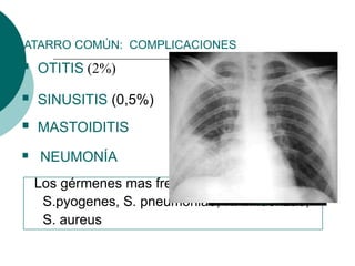 CATARRO COMÚN: COMPLICACIONES
 OTITIS (2%)
 SINUSITIS (0,5%)
 MASTOIDITIS
Los gérmenes mas frecuentes son:
S.pyogenes, S. pneumoniae, H. Influenzae,
S. aureus
 NEUMONÍA
 