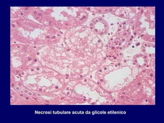     Necrosi tubulare acuta da glicole etilenico 