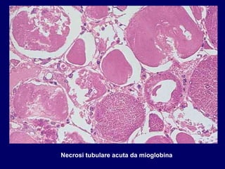 Necrosi tubulare acuta da mioglobina 