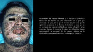El síndrome de Stevens-Johnson y la necrólisis epidérmica
tóxica son dos formas de una enfermedad de la piel que
amenaza a la vida, en la que la muerte celular hace que la
epidermis se separe de la dermis. El síndrome se cree que es
un complejo de hipersensibilidad que afecta a la piel y a las
mucosas. Aunque la mayoría de casos sea idiopática (causa
desconocida), la principal de las causas sabidas es la
medicación, seguida de infecciones y, raras veces, cánceres.
 