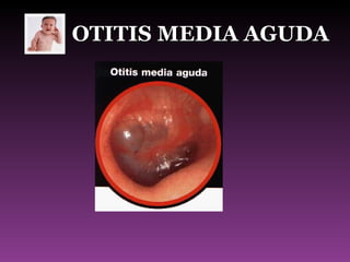 OTITIS MEDIA AGUDA 