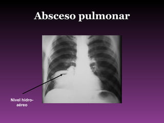 Absceso pulmonar Nivel hidro-aéreo 
