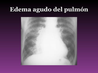 Edema agudo del pulmón 