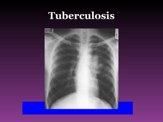 Tuberculosis 
