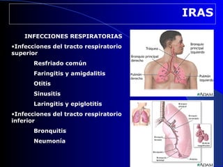 IRAS
    INFECCIONES RESPIRATORIAS
•Infecciones del tracto respiratorio
superior
       Resfriado común
       Faringitis y amigdalitis
       Otitis
       Sinusitis
       Laringitis y epiglotitis
•Infecciones del tracto respiratorio
inferior
       Bronquitis
       Neumonía
 