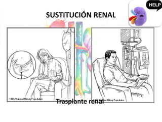 Trasplante renal
SUSTITUCIÓN RENAL
 