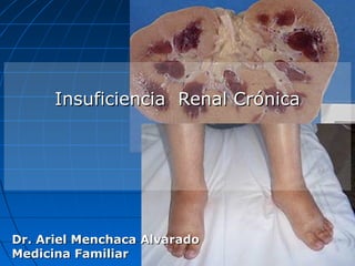 Insuficiencia Renal Crónica




Dr. Ariel Menchaca Alvarado
Medicina Familiar
 