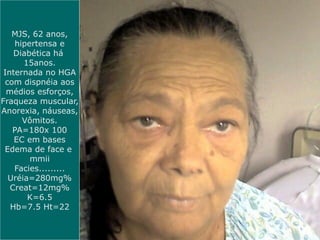 MJS, 62 anos,
hipertensa e
Diabética há
15anos.
Internada no HGA
com dispnéia aos
médios esforços,
Fraqueza muscular,
Anorexia, náuseas,
Vômitos.
PA=180x 100
EC em bases
Edema de face e
mmii
Facies.........
Uréia=280mg%
Creat=12mg%
K=6.5
Hb=7.5 Ht=22
 