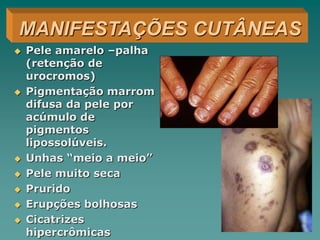  Pele amarelo –palha
(retenção de
urocromos)
 Pigmentação marrom
difusa da pele por
acúmulo de
pigmentos
lipossolúveis.
 Unhas “meio a meio”
 Pele muito seca
 Prurido
 Erupções bolhosas
 Cicatrizes
hipercrômicas
MANIFESTAÇÕES CUTÂNEAS
 