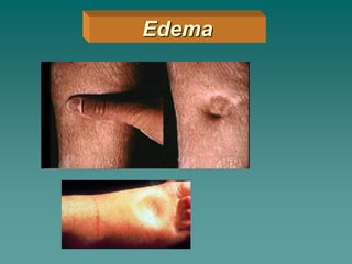 Edema
 