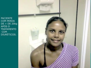 pPACIENTE
COM PERDA
DE + DE 20kg
APÓS O
TRATAMENTO
COM
DIURÉTICOS.
 
