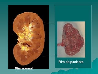 Rim normal
Rim da paciente
 