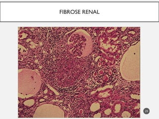 29
FIBROSE RENAL
 