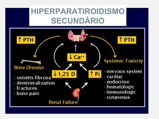 HIPERPARATIROIDISMO
SECUNDÁRIO
 