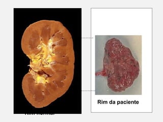 Rim normal
Rim da paciente
 