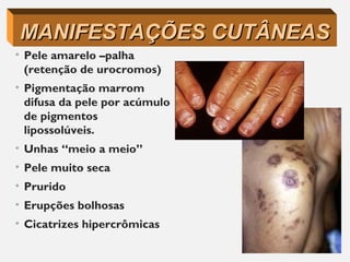 • Pele amarelo –palha
(retenção de urocromos)
• Pigmentação marrom
difusa da pele por acúmulo
de pigmentos
lipossolúveis.
• Unhas “meio a meio”
• Pele muito seca
• Prurido
• Erupções bolhosas
• Cicatrizes hipercrômicas
MANIFESTAÇÕES CUTÂNEASMANIFESTAÇÕES CUTÂNEAS
 