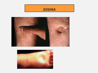 EDEMA
 