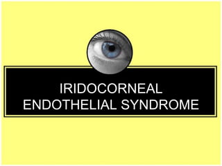 IRIDOCORNEAL
ENDOTHELIAL SYNDROME
 