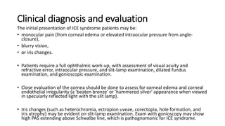 Iridocorneal endothelial syndrome | PPTX
