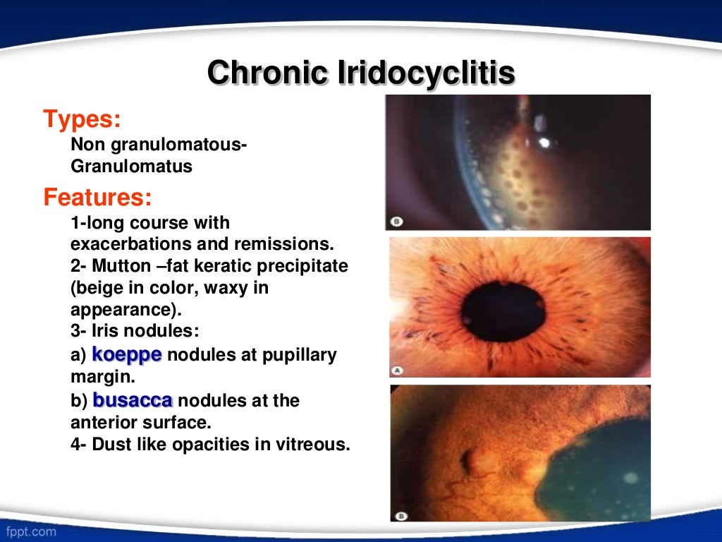 Iridocyclitis