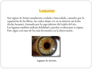 Lagunas Son signos de forma usualmente ovalada o lanceolada, causados por la separación de las fibras, las cuales dejan ver en su interior un lecho (lecho lacunar), formado por la capa inferior del tejido del iris. Las lagunas también indican debilidad y pueden evolucionar a criptas. Este signo será uno de los más frecuentes en la observación. Lagunas de alveolo. 